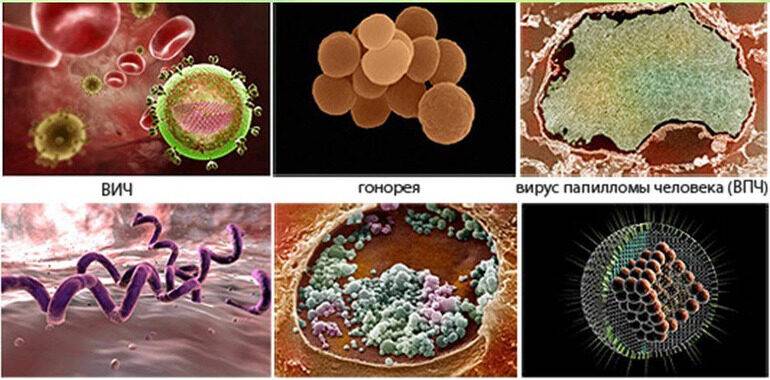 venericheskie_zabolevaniya
