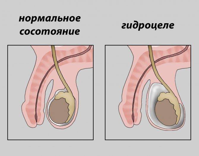 vodyanka-yaichka-u-muzhchin-prichiny-simptomy-na-foto-i-lechenie