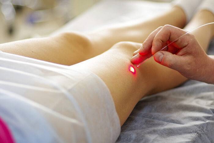 varicose-laser-treatment